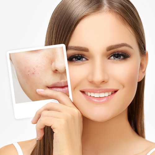 Chica sosteniendo fotografía antes de su tratamiento con cosméticos antiacné